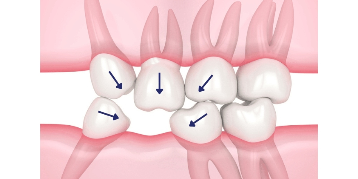 Restore Your Smile: Missing Tooth Bakersfield and Dental Crowns Bakersfield by San Dimas Dental Care