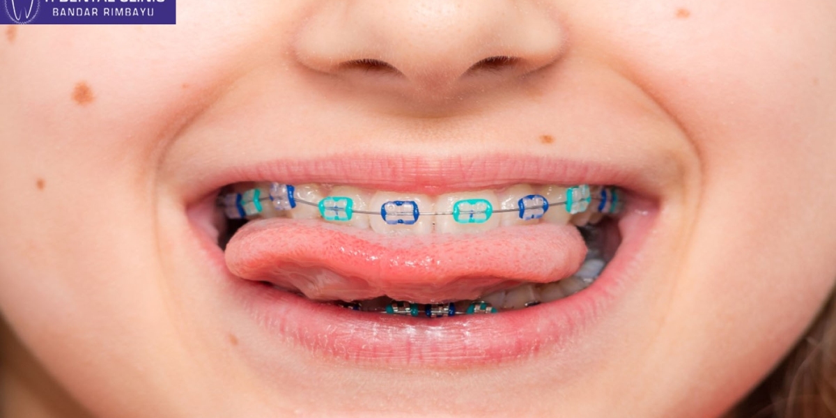 Dental Implants: A Permanent Solution to Tooth Loss at Tidental