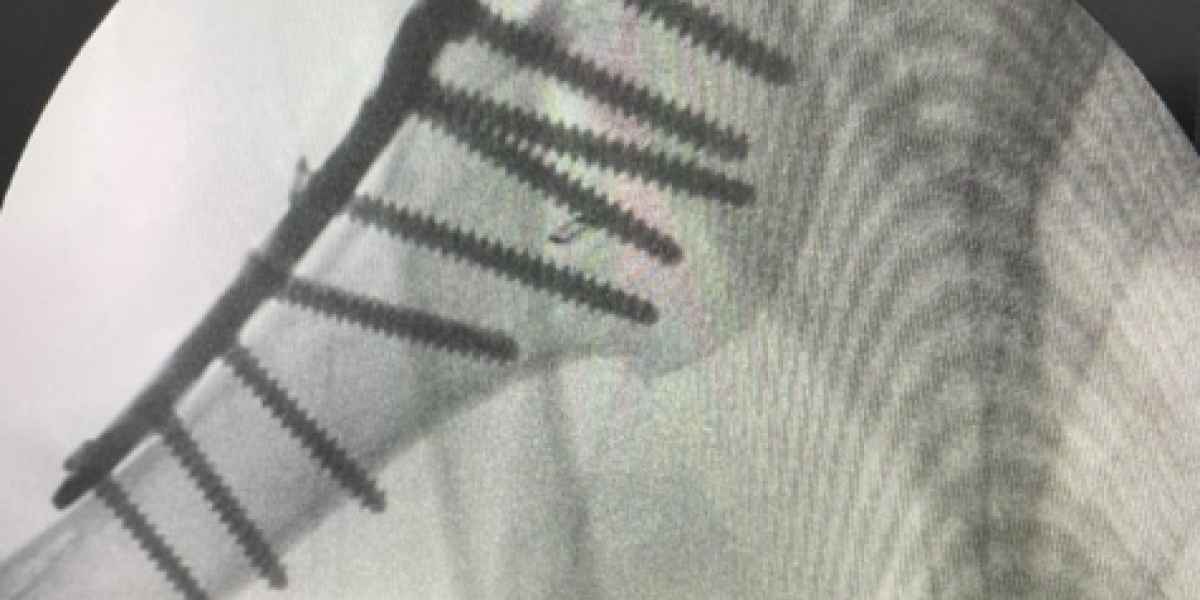 Open Reduction Internal Fixation Surgery: Trusted Treatment from an Expert Orthopedic Surgeon in London
