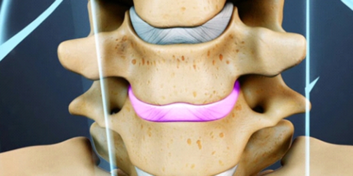 Motion Sparing Neck Surgeries