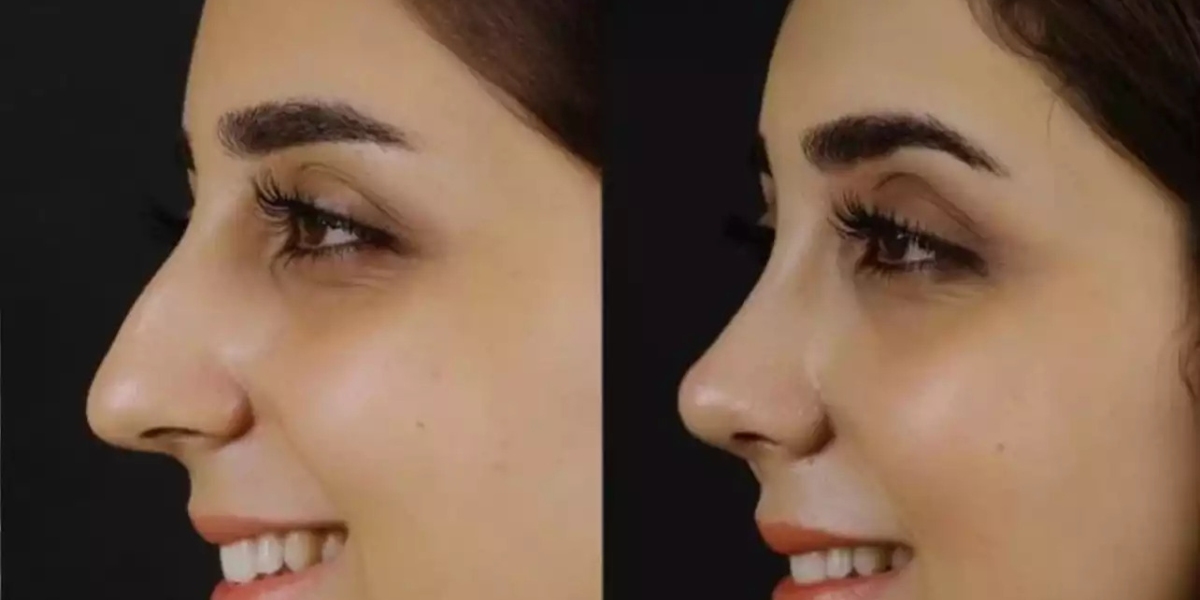 Top 5 Reasons to Choose the Best Septoplasty Surgeon in Dubai
