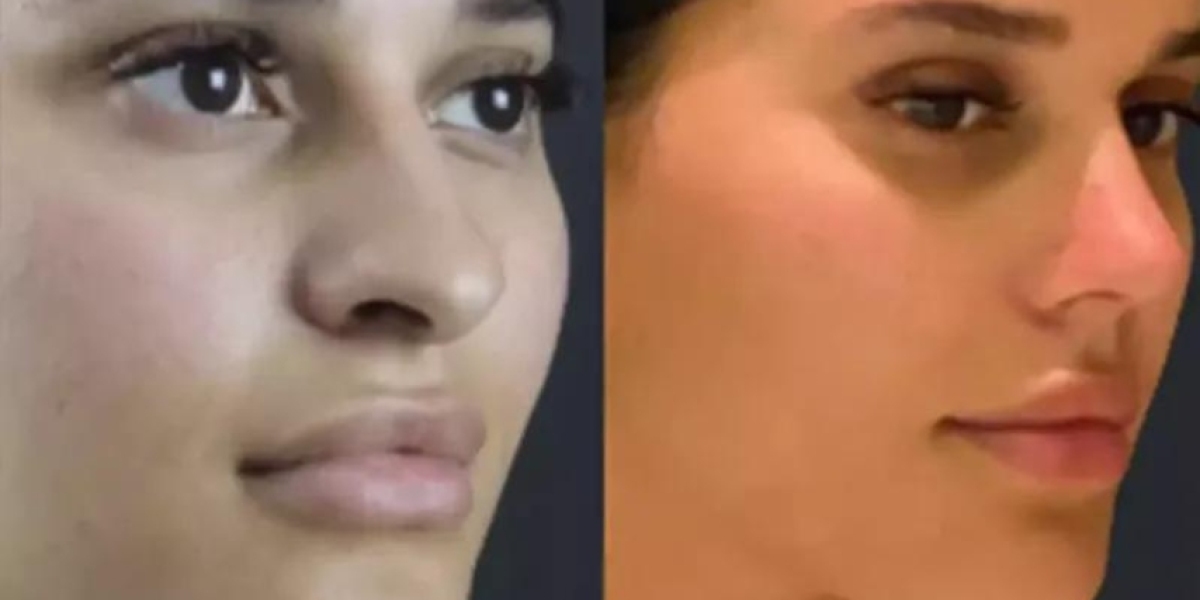 Dubai’s Best Rhinoplasty Surgeon: Patient Testimonials & Results