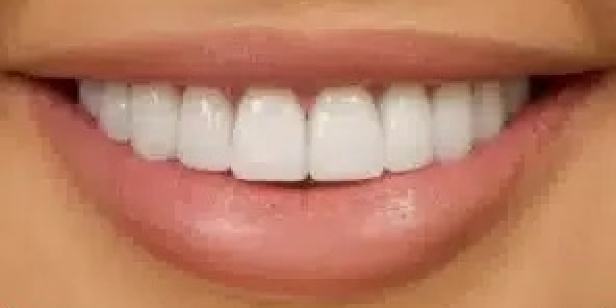 Are Dental Veneers Safe? Debunking Common Myths