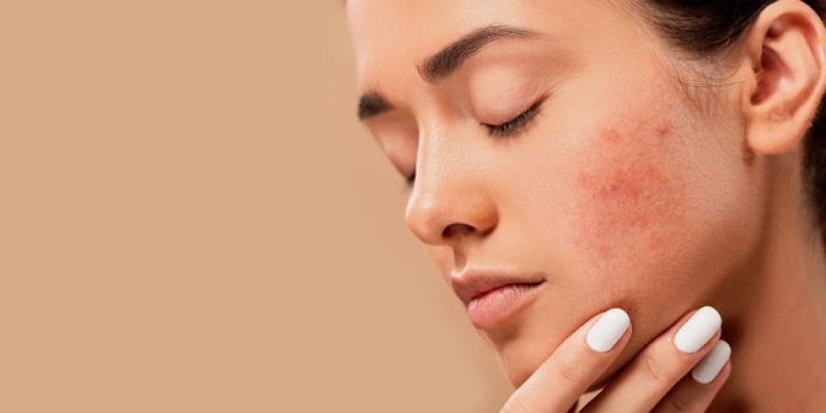 Acne Treatment: Simple Steps for a Clearer Face